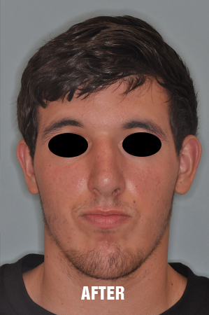 Patient After