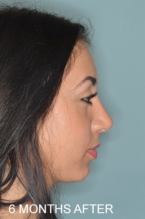 Patient After