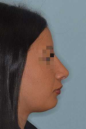 Patient After