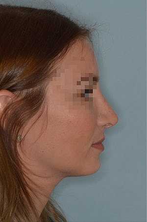 Patient After