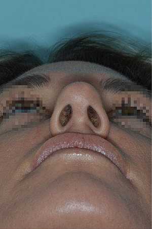 Patient After
