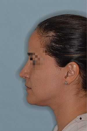 Patient After