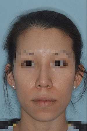 Patient After