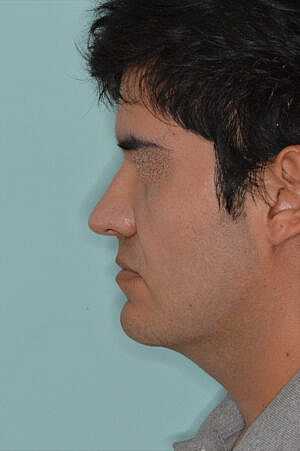 Patient After