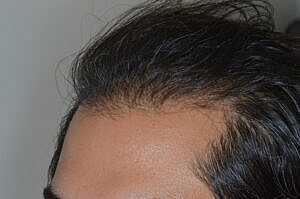 Patient After